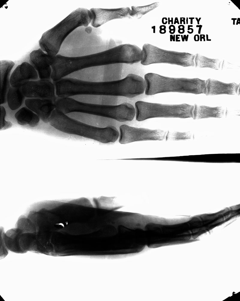 Photograph of X-Rays of Hand, Charity Hospital. George François Mugnier, c. 1880–1920. Collodion on glass plate, 8 x 10 inches. Louisiana State Museum 09813.0216.